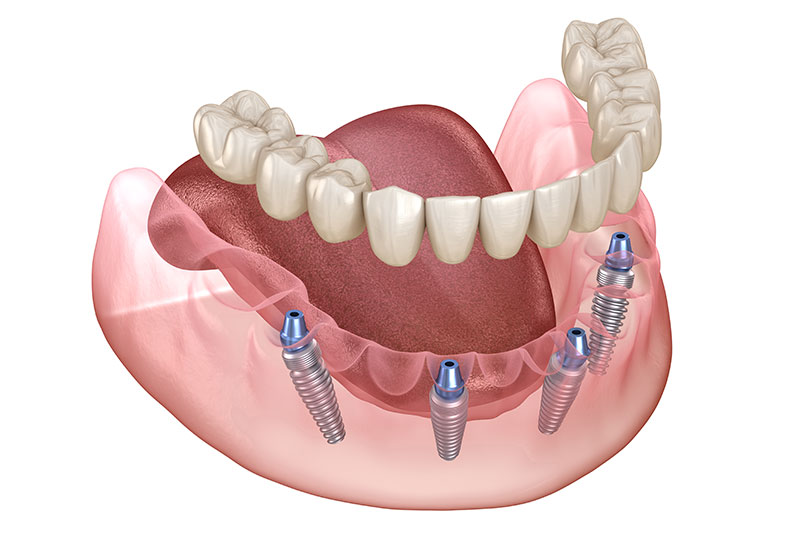 Quality Dental Treatments in Cypress