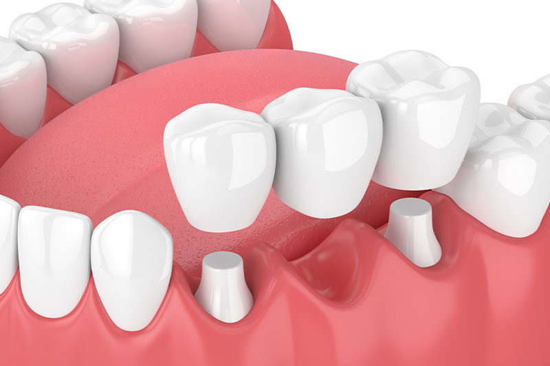 Complete Dental Bridges in Cypress