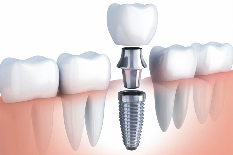 Quality Dental Treatments in Cypress