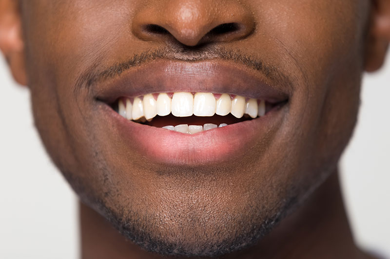 Complete Dental Bonding in Cypress