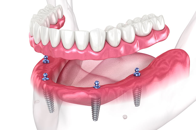 Implant-Supported Dentures in Cypress