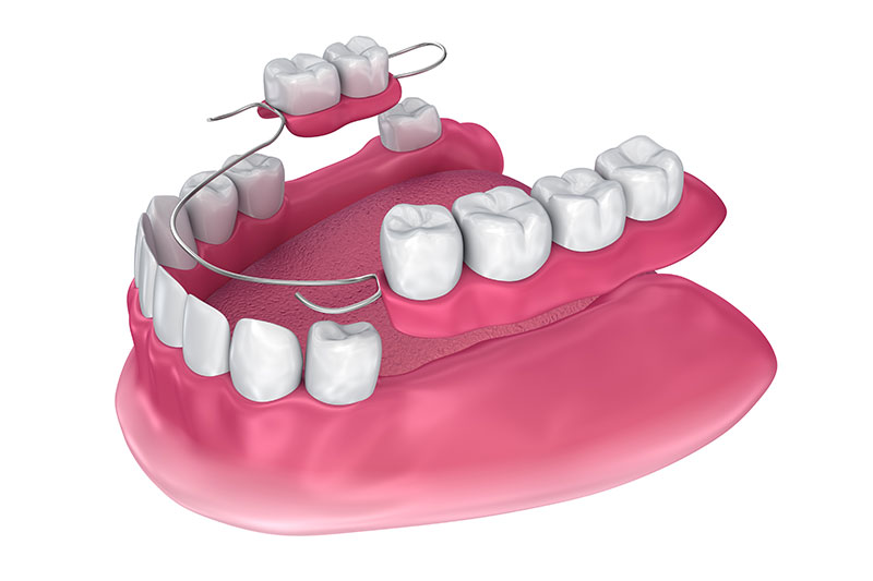Complete Dental Partial Dentures in Cypress