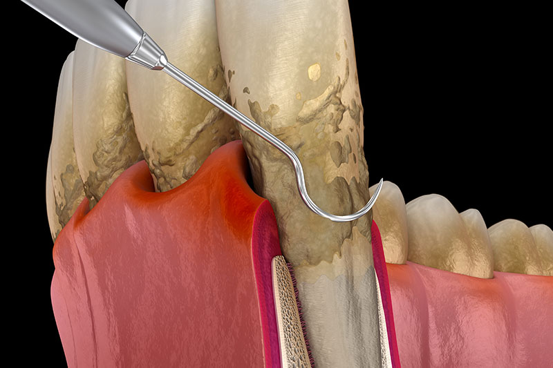 Periodontal (Gum) Treatments in Cypress