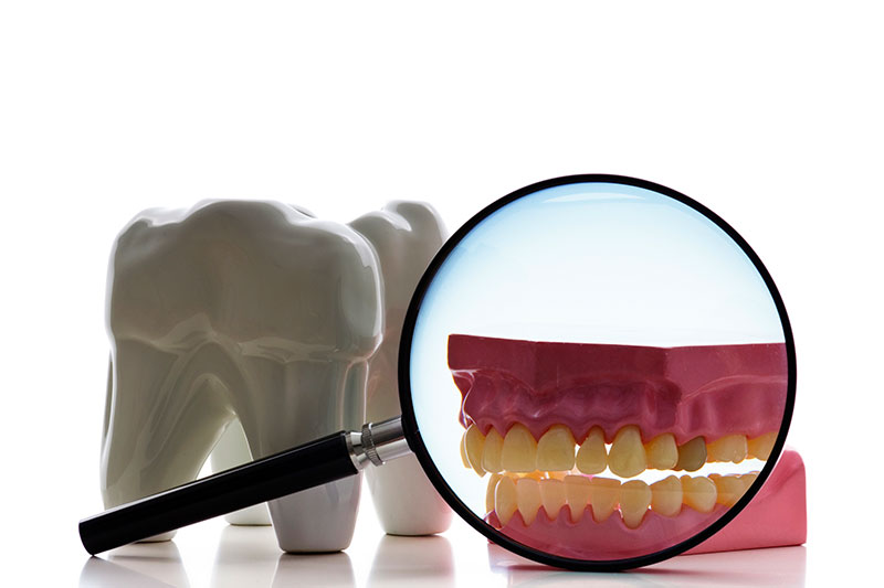 Root Canals in Cypress