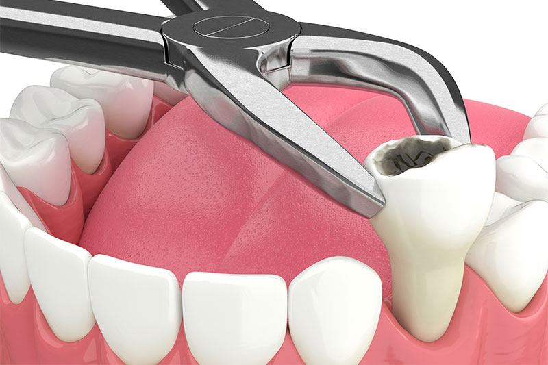 Complete Dental Extractions in Cypress