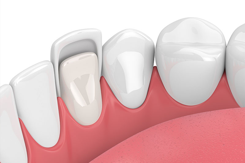 Dental Veneers in Cypress