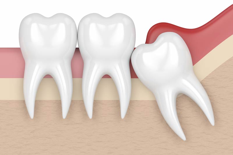 Wisdom Teeth in Cypress